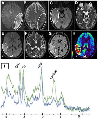 Frontiers | Case report: MELAS and concomitant presumed ...