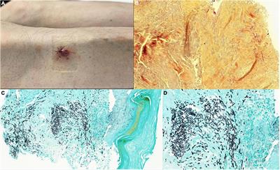 Frontiers | Case report: Disseminated Scedosporium apiospermum ...