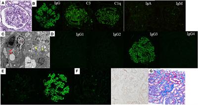 Frontiers | Proliferative glomerulonephritis with monoclonal ...