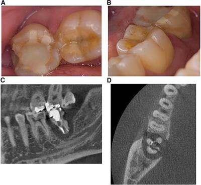 Frontiers  Adhesion of Teeth