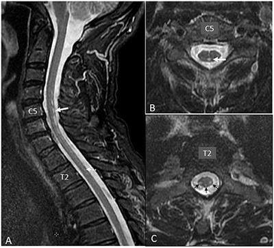 Frontiers | Case report: Motor neuron disease phenotype associated with ...