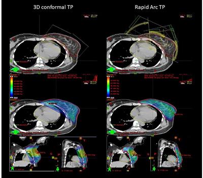 Frontiers | Different meaning of the mean heart dose between 3D-CRT and ...