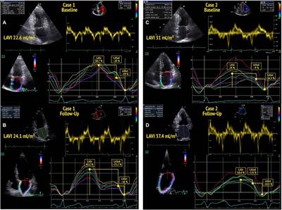 A systematic review and meta-analysis of the normal reference value of the  longitudinal left atrial strain by three dimensional speckle tracking  echocardiography