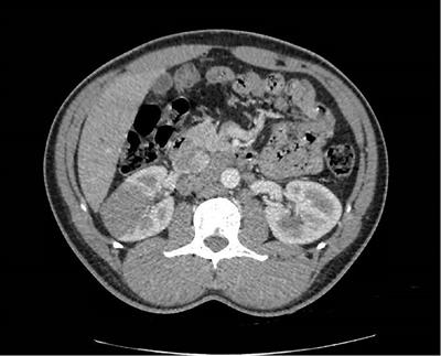 Frontiers | Surgical and oncological management of renal medullary ...