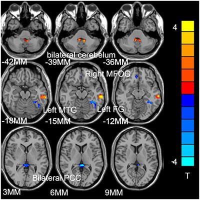 Frontiers | Abnormal hubs in global network as potential neuroimaging ...