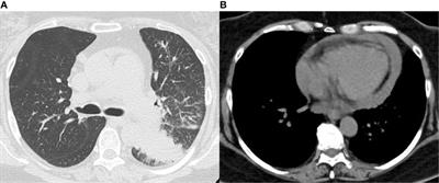 Frontiers | Case report: Electrocardiographic changes in pembrolizumab ...