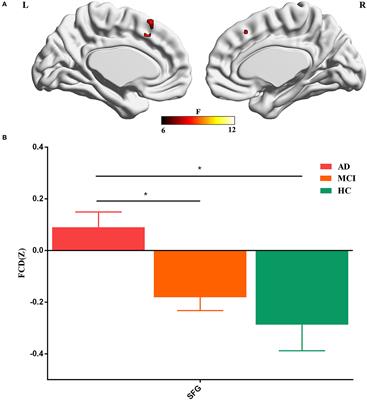 Frontiers | Distinct profiles of functional connectivity density ...