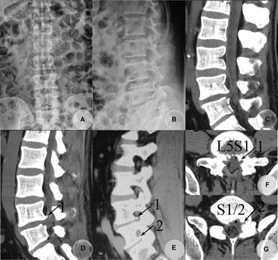 Frontiers | Complete lumbarization with calcified disc herniations at ...