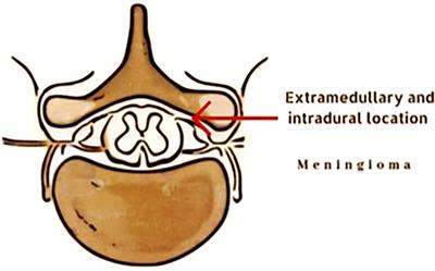 Frontiers Spinal Meningiomas From Biology To Management A