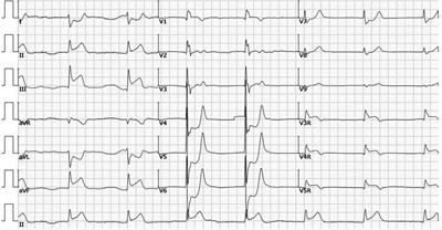 Frontiers | Case Report: A balloon-based technique to remove a pearl ...