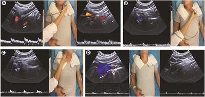 Frontiers | Bow Hunter's syndrome with clicking sounds: A rare etiology ...