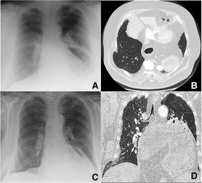 Frontiers | Case Report: Spontaneous lung intercostal hernia series and ...