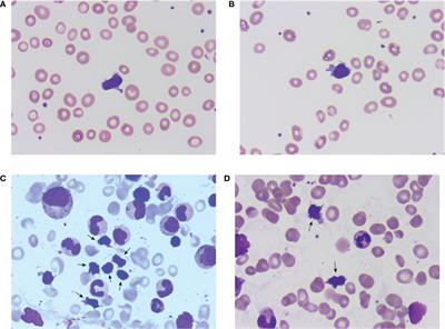 Frontiers | Successful treatment of a pure red-cell aplasia patient ...