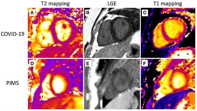 T2 Relaxation Times at Cardiac MRI in Healthy Adults: A Systematic