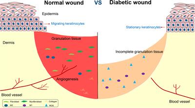 Frontiers  Exploring the contribution of pro-inflammatory cytokines to  impaired wound healing in diabetes