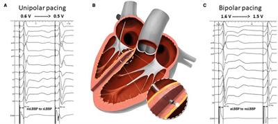 Frontiers | Bipolar anodal septal pacing with direct LBB capture ...