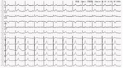 Frontiers | Case report: Implantable cardioverter-defibrillator ...