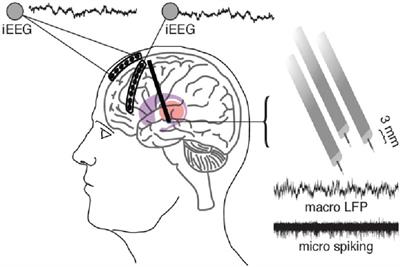 Treating Severe Depression with On-Demand Brain Stimulation