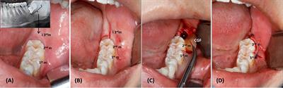 Influence of immediate post-extraction socket irrigation on development of  alveolar osteitis after mandibular third molar removal: a prospective  split-mouth study, preliminary report