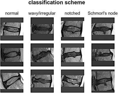 Frontiers | Automatic classification of the vertebral endplate lesions ...