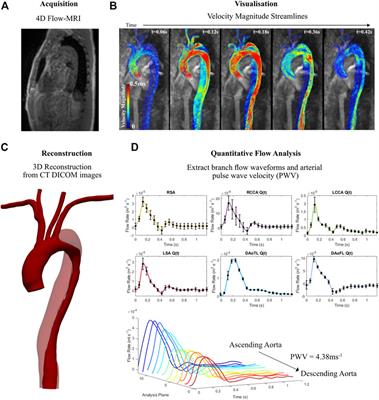 Frontiers | Calibration of patient-specific boundary conditions for ...