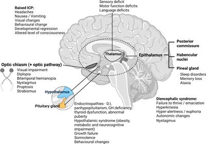 Outcomes and surgical approaches for pineal region tumors in children: 30  years' experience in: Journal of Neurosurgery: Pediatrics Volume 32 Issue 2  (2023) Journals