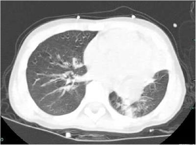 Frontiers | Tropheryma whipplei-induced plastic bronchitis in children ...