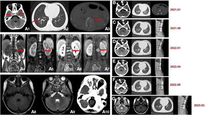 Frontiers | Case report: Multiple epstein-barr virus-associated smooth ...