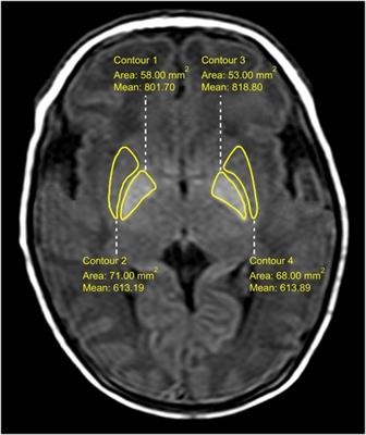 Frontiers | Globus pallidus/putamen T1WI signal intensity ratio in ...