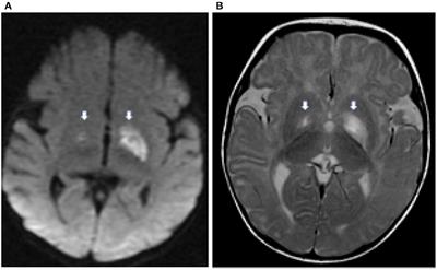 Frontiers | A milder form of molybdenum cofactor deficiency type A ...