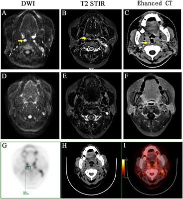 Frontiers | Distribution pattern of medial group retropharyngeal lymph ...