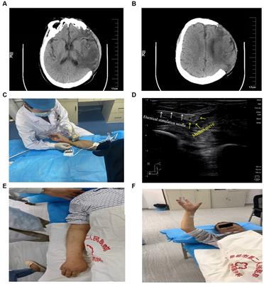 Neuromuscular Electrical Stimulation for Motor Restoration in Hemiplegia