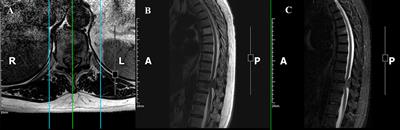 Frontiers Spinal Meningiomas From Biology To Management A