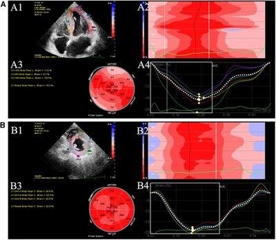 Cureus, Left Ventricular Global Longitudinal Strain in Patients With  COVID-19 Infection