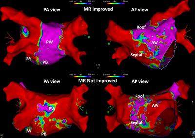 Clinical significance of left ventricular reverse remodeling after catheter  ablation of atrial fibrillation in patients with left ventricular systolic  dysfunction - ScienceDirect