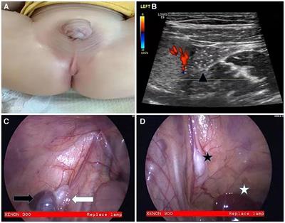 Firm lesion on the lateral thigh  Cleveland Clinic Journal of Medicine