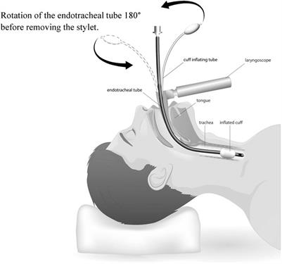 Frontiers | Postoperative sore throat: prophylaxis and treatment