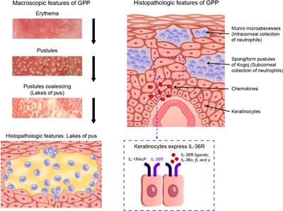 Frontiers | The role of the interleukin-36 axis in generalized pustular ...