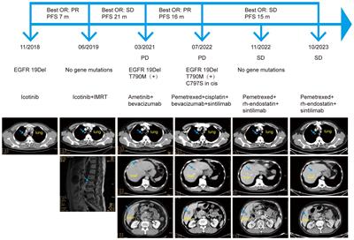 Frontiers | Case report: Sustained remission after combined sintilimab ...