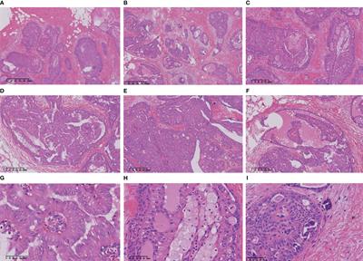 Frontiers | Case report: Tall cell carcinoma with reversed polarity of ...