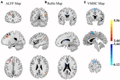 Frontiers  Abnormal brain spontaneous activity in major