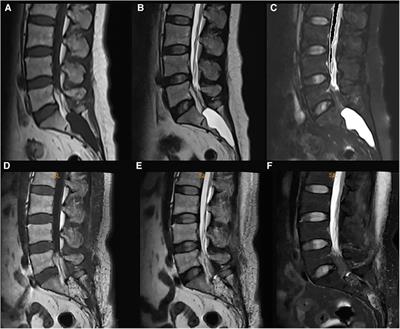 Frontiers | Efficacy of neuroendoscopic-assisted surgery in the ...