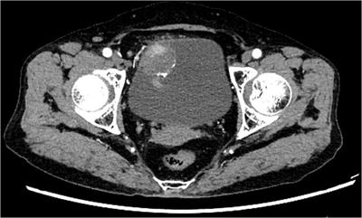 Frontiers | Clinical efficacy analysis of partial cystectomy and ...