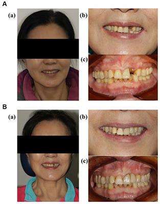 Frontiers  Immediate Outcomes and Benefits of 3D Printed Braces