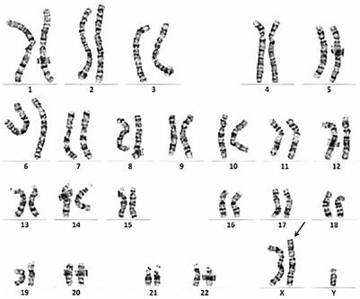 Frontiers | Case report: Klinefelter syndrome may protect against the ...