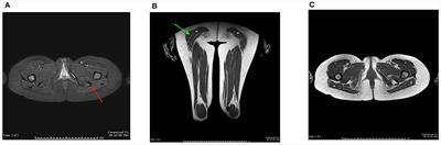 Frontiers | Case report: Dihydropyridine receptor (CACNA1S) congenital ...