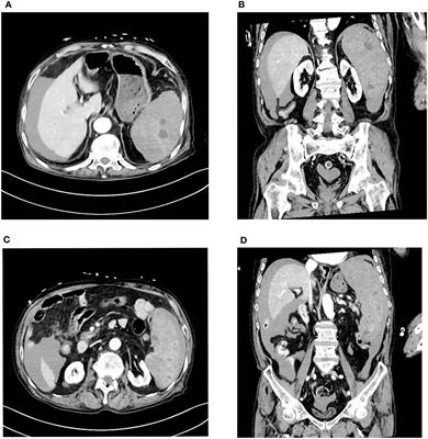 Frontiers | Spontaneous splenic rupture as the initial symptom of ...