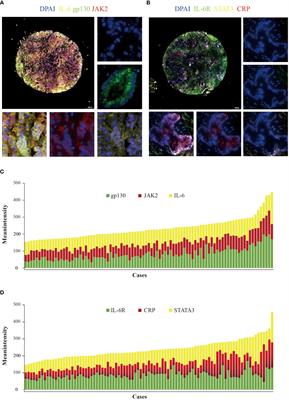 Expression and clinical significance of interleukin-6 pathway in cholangiocarcinoma