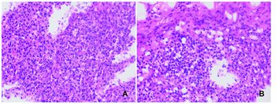 Kikuchi-Fujimoto disease evolves into lupus encephalopathy characterized by venous sinus thrombosis: a case report