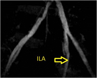 Frontiers | Endovascular intervention with intravascular ultrasound ...